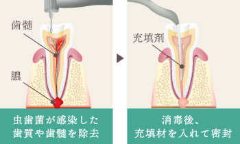 虫歯菌が感染した歯質や歯髄を除去し、消毒後、充填材を入れて密封